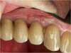 Remplacement de plusieurs dents par plusieurs implants - après