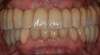 Facettes éramique sur implants et dents naturelles - après