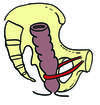 anatommie du bassin avec diminue de l'angle ano-rectal