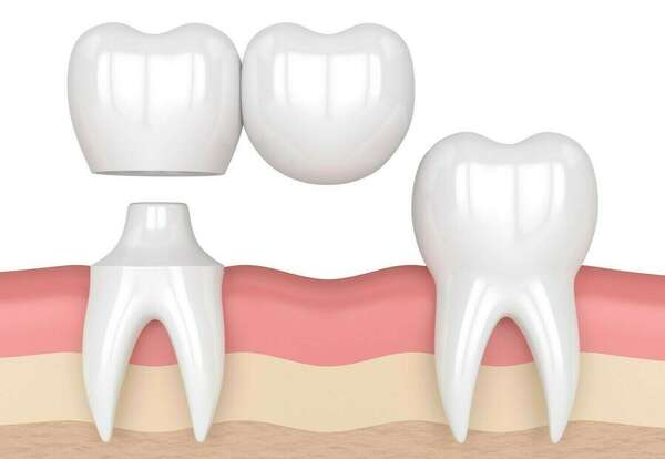 Bridge cantilever et bridge collé