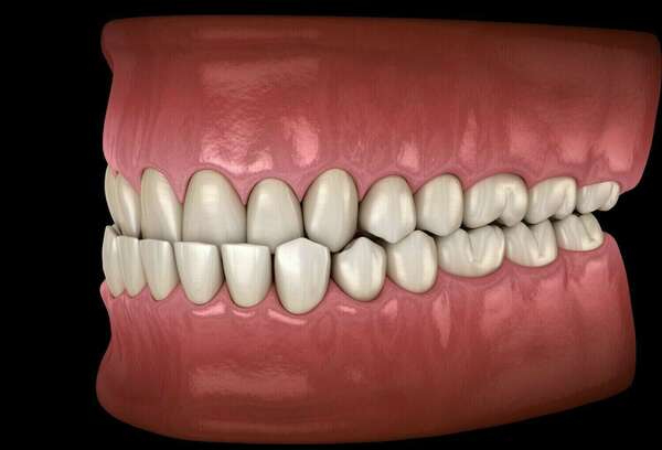 L’occlusion dentaire