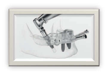 Le concept de traitement All-on-4 /All-on-6 - Evreux - 27