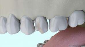 Allongement coronaire