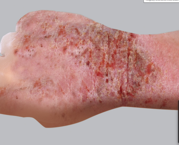 l'hypnose et l'eczéma