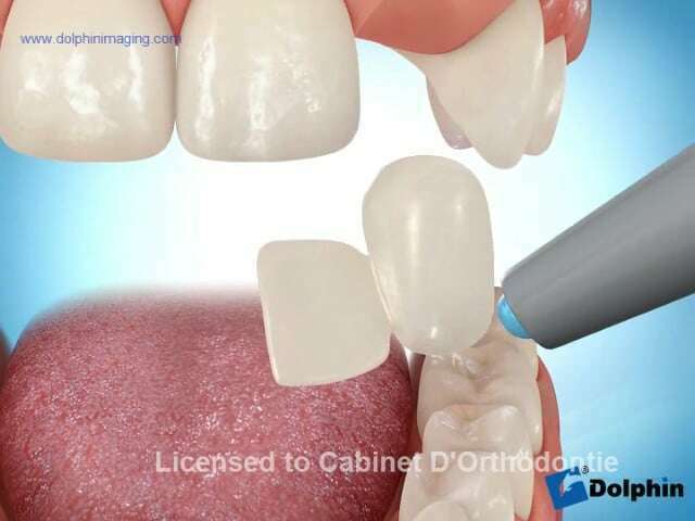 Bridge collé