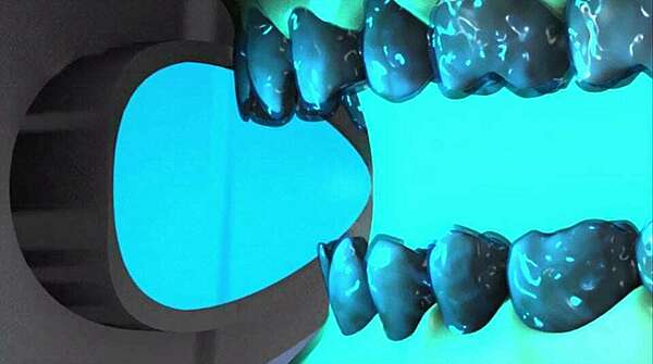 Blanchiment au fauteuil