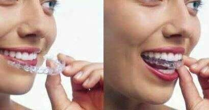 L'orthodontie invisible