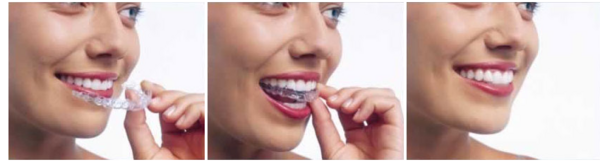 La Technique Invisalign® – Align Technology