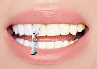 LE BLANCHIMENT DES DENTS