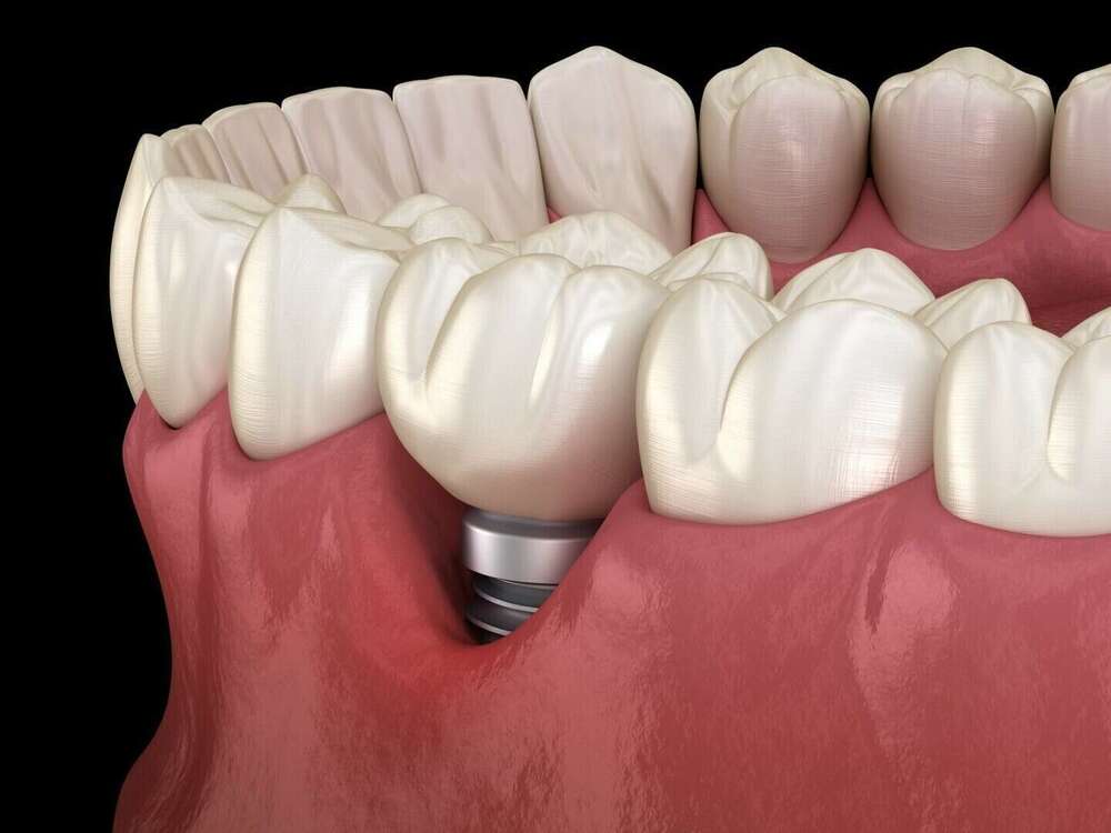 La péri-implantite