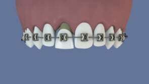 Extraction en orthodontie et réhabilitation par implant