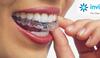 La Technique Invisalign® – Align Technology
