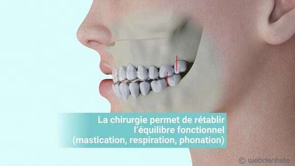 La chirurgie orthognatique – rétrognathie maxillaire