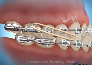 Correction avec élastique classe 3.
