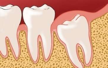 LES DENTS DE SAGESSE