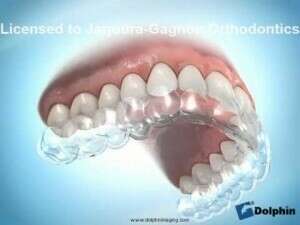 Gouttière de contention