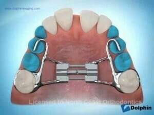 Disjonction orthodontique