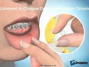 Cire en orthodontie