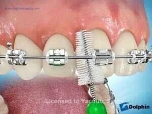 Hygiène brossettes orthodontie