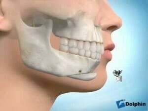 Génioplastie d’avancement