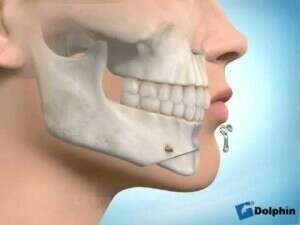 Génioplastie de réduction