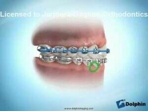 Incisive latérale, Fermeture d’espace