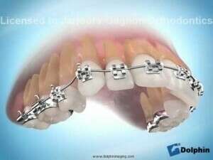 Incisive mandibulaire