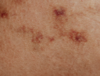 eczéma