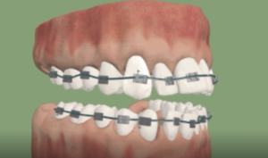 Traitement sans extraction