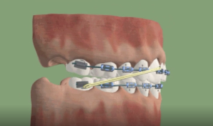 Traitement inter-maxillaire de Classe II