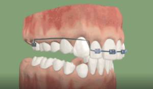 Traitement de la supraclusion (incisive)