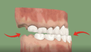 Avancée orthopédique du maxillaire supérieur