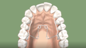 Expansion transversale