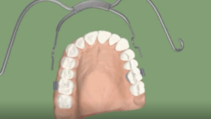 Force Extra Orale de Classe II sur bagues