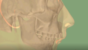 Propulsion mandibulaire thérapeutique fonctionnelle de Classe II