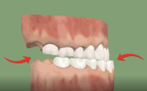 Force Extra Orale de Classe III