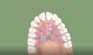 Expansion transversale, appareil amovible
