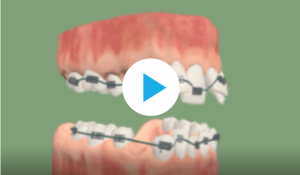 Traitement avec extraction de prémolaire (encombrement dentaire)