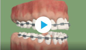 Traitement sans extraction