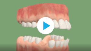 Traitement de biproalveolie avec extractions de prémolaires