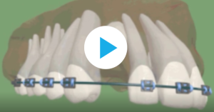 Mise en place de canines incluses