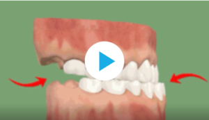 Avancée orthopédique du maxillaire supérieur