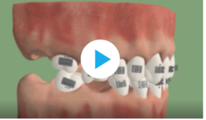 Préparation pré-prothétique orthodontique