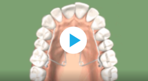 Expansion transversale