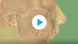 Propulsion mandibulaire thérapeutique fonctionnelle de Classe II