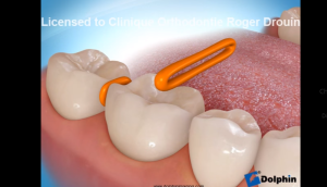 LIGATURE D ECARTEMENT