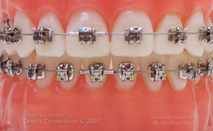 BRACKETS AUTOLIGATURANT