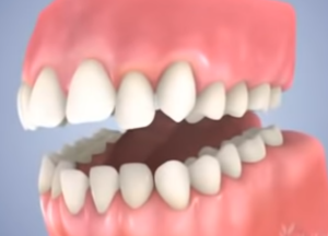 Traitement multi-attaches