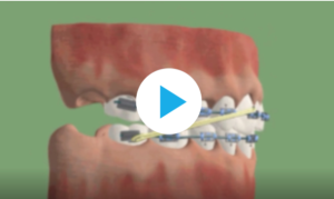 Traitement inter-maxillaire de Classe II