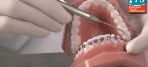 Appareil dentaire : C'est quoi les bagues ?